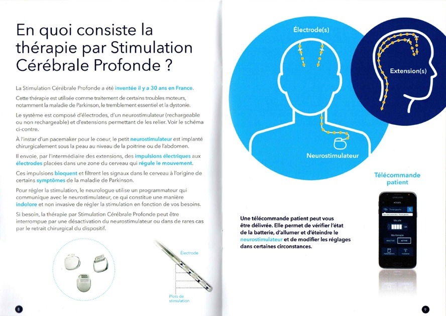En quoi consiste la thérapie par Stimulation Cérébrale Profonde